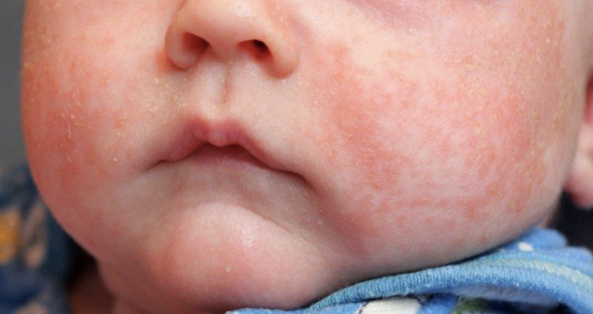 Skin Problems Your Baby May Suffer From!