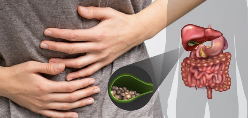 How To Minimize The Risk Of Gallstones? - My Doctor My Guide